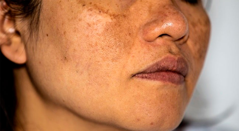 O Melasma tem cura? Como tratar o melasma?