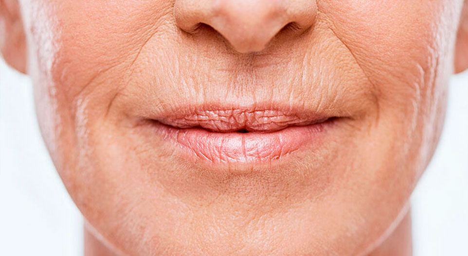 Rugas profundas ao redor da boca tem tratamento?